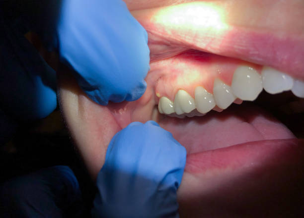 Best Emergency Tooth Extraction  in Linden, TX