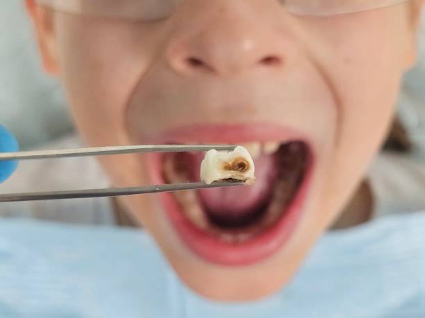 Best Emergency Tooth Extraction  in Linden, TX